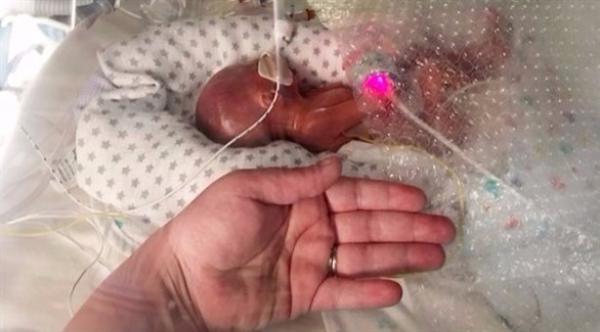 طفل معجزة ولد وزنه نصف كيلو يخالف توقعات الأطباء