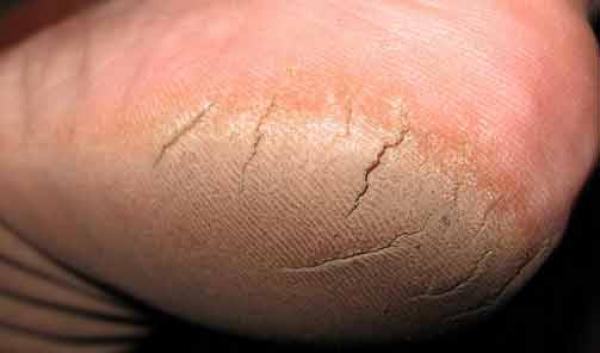 لماذا يتشقق كعب القدمين؟ اهم الاسباب والنصائح