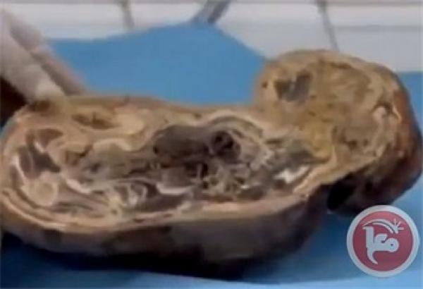 أطول حمل في التاريخ لسيدة مغربية استمر 48 عاماً