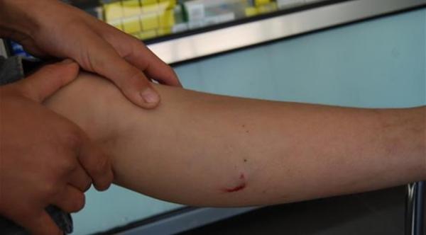 عدم التئام جروح الساق يستلزم استشارة الطبيب فوراً