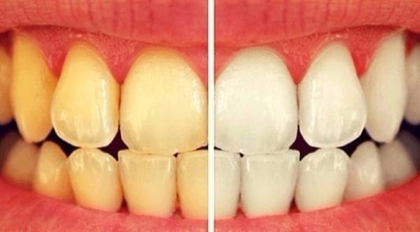 10 أطعمة ومشروبات تؤدي إلى اصفرار أسنانك