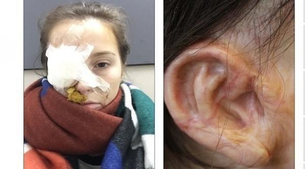 تستعيد وجهها المحترق بـ 70 عملية تجميل