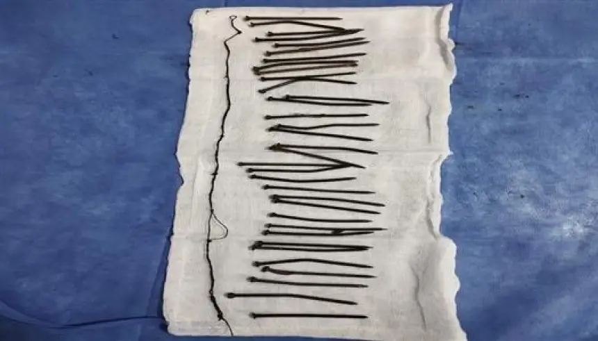 مصر.. فريق طبي ينقذ سيدة ابتلعت 34 مسمارا