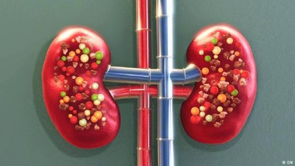 خمسة أسباب تعزز مخاطر الإصابة بحصوات الكلى