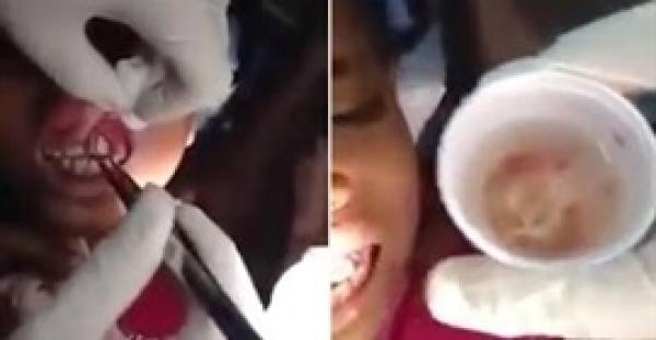 بالفيديو.. استخراج 15 دودة حية من فم طفلة