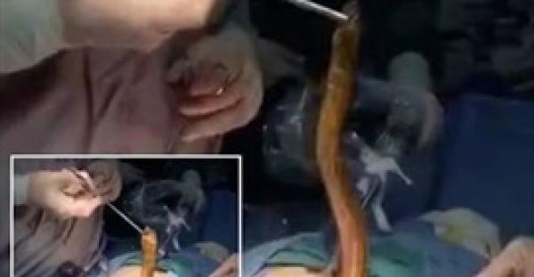 بالفيديو.. إخراج ثعبان حي طوله نصف متر من بطن مريض