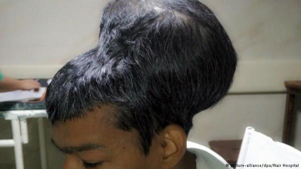 استئصال أكبر ورم دماغي في العالم بنجاح