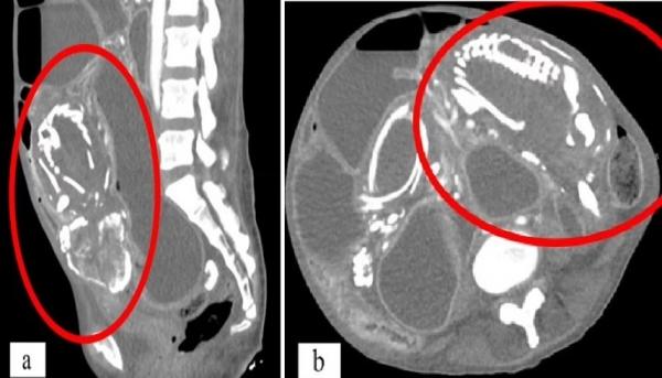 بسبب سوء التغذية الحاد.. وفاة امرأة حامل بسبب جنين ظل قرابة تسع سنوات داخل جسدها