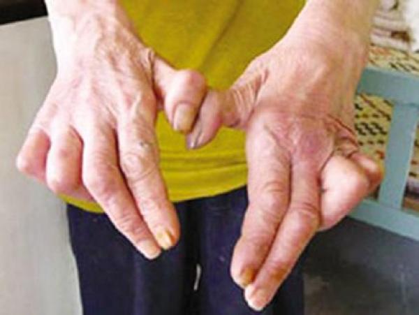 مرض الجذام خطر يهدد العالم