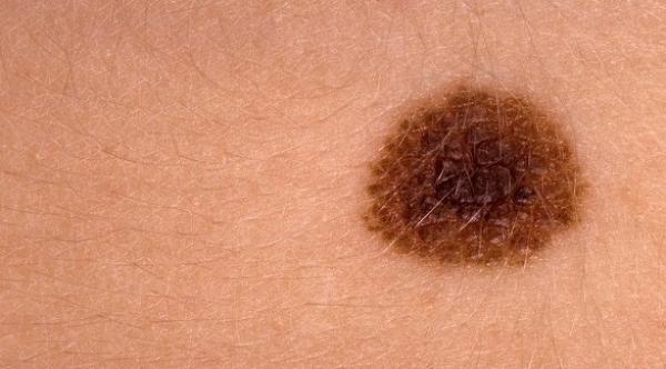 تغيرات الشامة تدق ناقوس الخطر