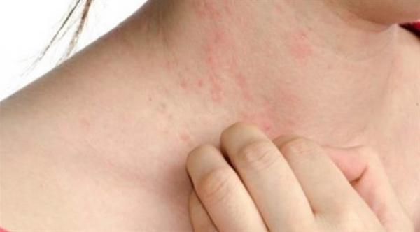 أعراض تدل على الإصابة بحساسية الهستامين