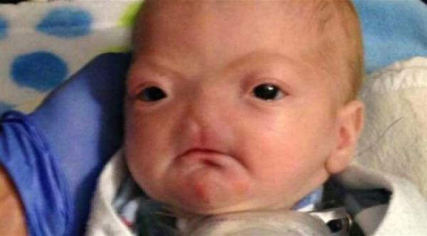 بالصور: ولادة طفل كامل الصحة ولكن بلا أنف