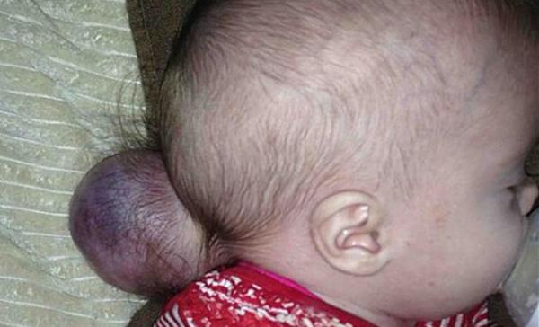 طفلة تولد بكتلة خارج جمجمتها تحتوي جزءاً من الدماغ
