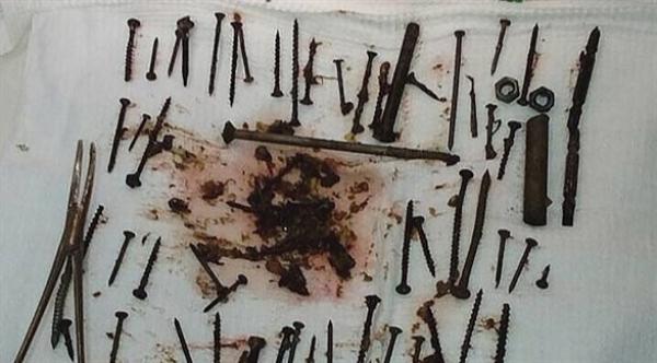 العثور على 152 جسماً معدنياً داخل معدة روسية