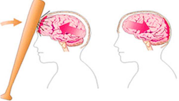 في حالة اصطدام الرأس بقوة، ماذا افعل ؟