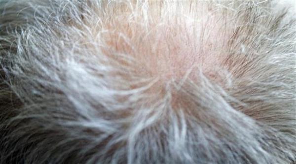 دراسة تكشف السبب الحقيقي للصلع