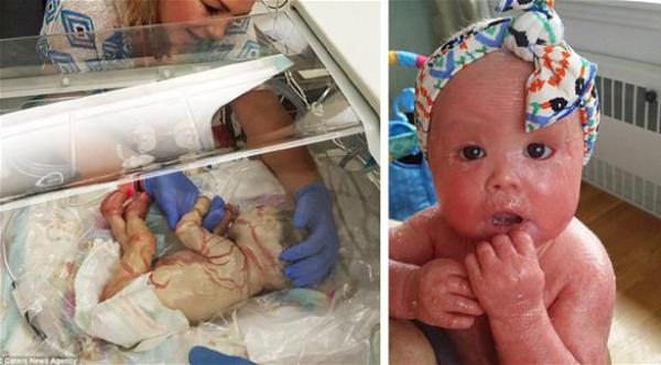 بالصور: رضيعة يتقشر جلد جسمها بالكامل كل 4 ساعات