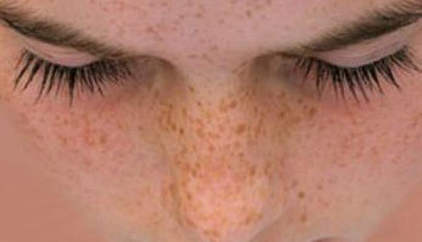 ما أسباب النمـش وطرق علاجه؟
