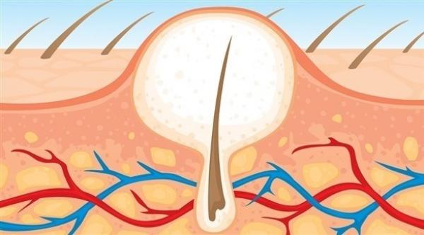 كيف تنمو الشعرة تحت الجلد وما علاجها؟