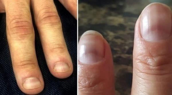 علامات في أظافرك تدل على أنه سبق وأن أصبت بكورونا