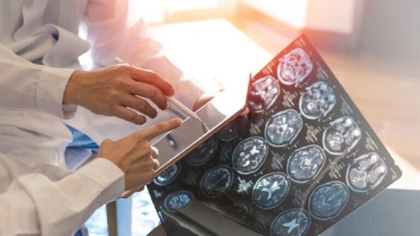 أطباء يبتكرون طريقة جديدة لتدمير خلايا الورم في الدماغ