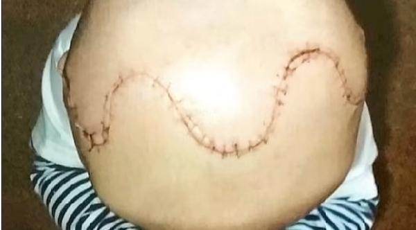 أطباء يقومون بتحطيم جمجمة طفل وإعادة تجميعها لإنقاذ دماغه من الانفجار داخلها