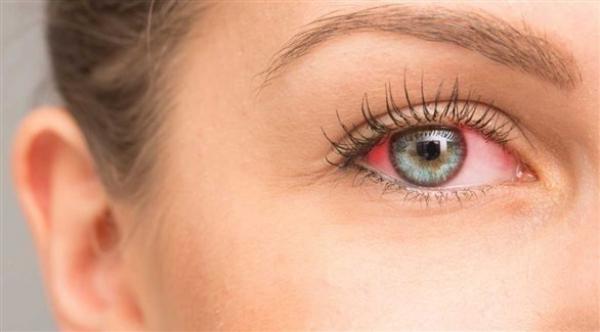 احمرار العين تنذر بالتهاب الملتحمة