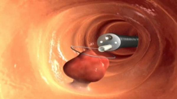 خمس قواعد لتقليل مخاطر الإصابة بسرطان القولون