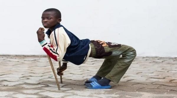 طفل يمشي على أربع بسبب مرض نادر