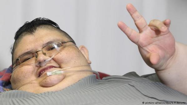 دراسة تربط بين زيادة الوزن والإصابة بأمراض الكبد