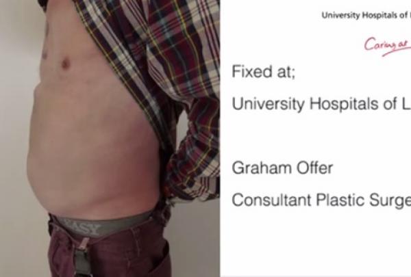 بالفيديو: بريطاني يصاب بورم في بطنه بحجم كرة قدم