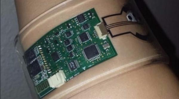 سوار ذكي يُشخص السكري والتليف الكيسي ويساعد في علاجهما