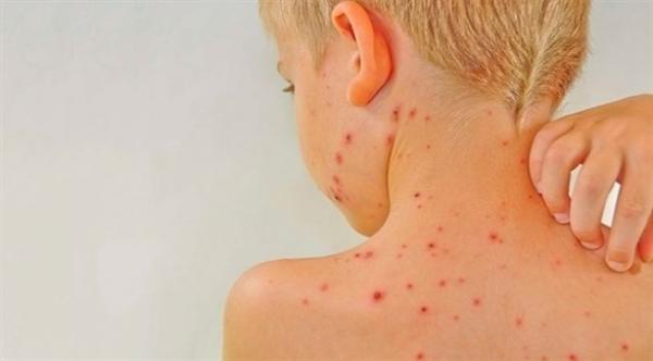 حكة الجلد بعد السباحة.. على ماذا تدل؟