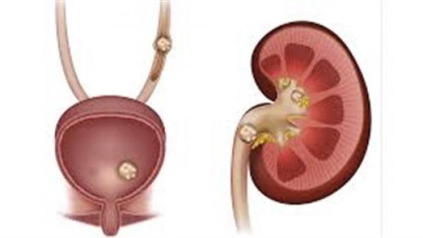 5 نصائح تحمي من الإصابة بتكوين حصوات الكلى والمثانة