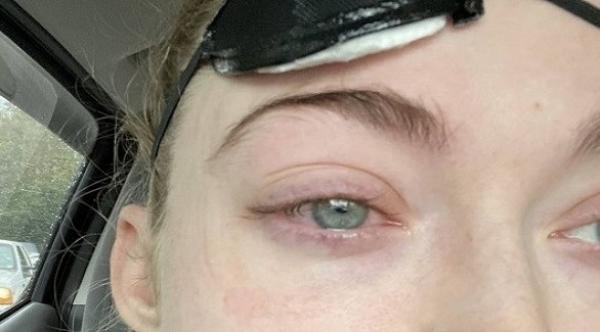 عدسات لاصقة تمزق الطبقة الخارجية من مقلة عين فنانة وترتكها طريحة الفراش
