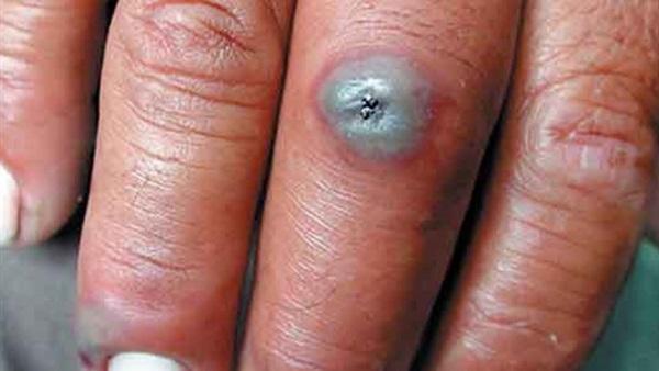 وزارة الصحة : تسجيل 9 حالات للإصابة بمرض"الجمرة الخبيثة" بإقليم ميدلت