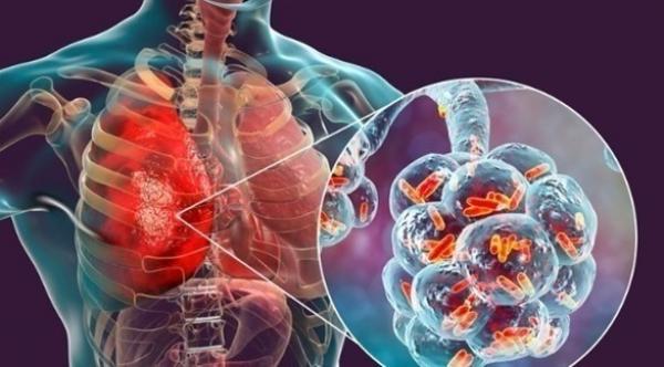 الليجيونيلا هي المسؤولة عن أغلب حالات الالتهاب الرئوي بالأرجنتين