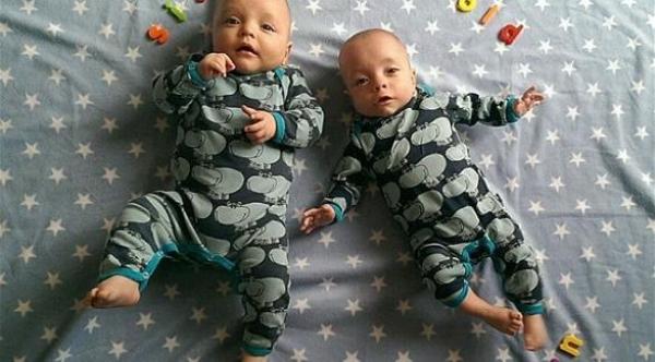بالصور: توأم أحدهما بنصف وزن الأخر