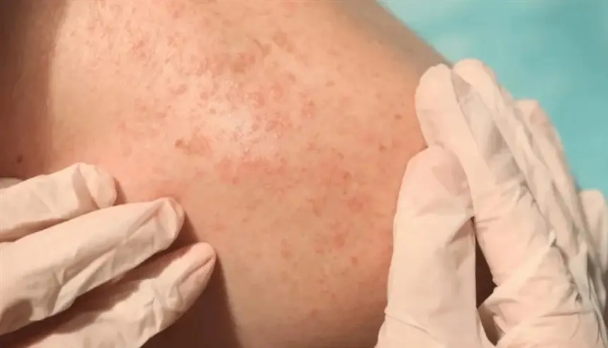 الأشعة فوق البنفسجية وراء 83% من إصابات الميلانوما عالمياً