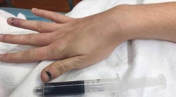 يتحول لون دمها للأزرق القاتم بسبب تناولها مسكنا للأسنان