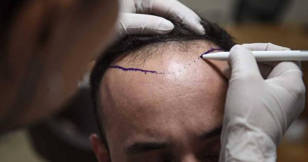 علماء يكتشفون علاجا لمشكلة الصلع التي تؤرق الملايين