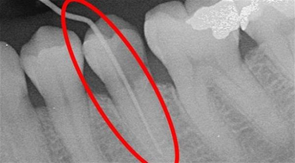 "سنبلة" طبيب أسنان تبقى داخل فم مريضة لعامين