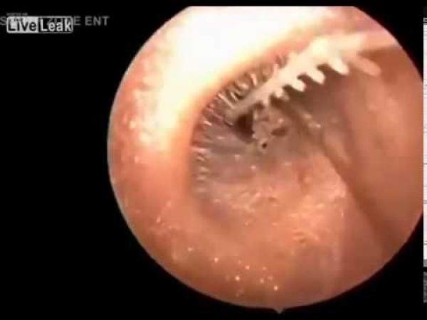 بالفيديو: لحظة إخراج حشرة ضخمة من أذن رجل