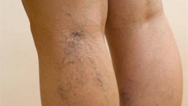 3 خطوات طبيعية لعلاج دوالي الساقين