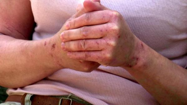 الإكزيما المزمنة – مرض مزعج ومحاولات لعلاجه