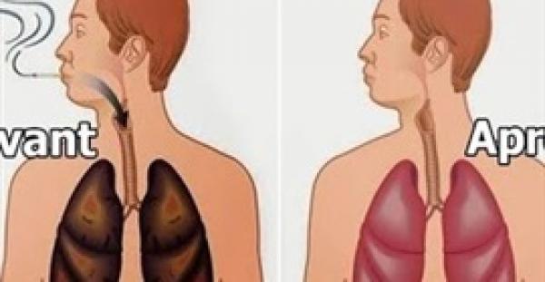 بالفيديو.. 4 أطعمة تحمي من الإصابة بسرطان الرئيتين