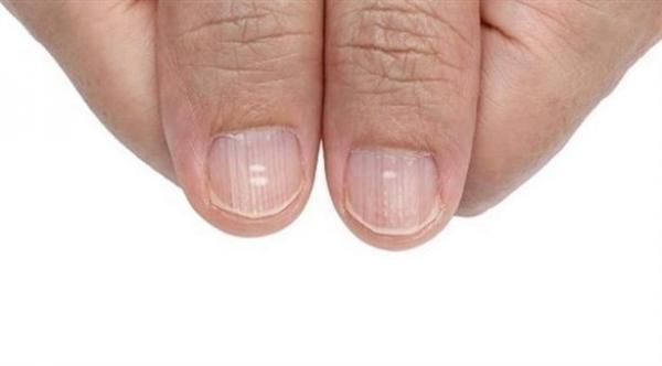 تغير شكل و لون الأظافر ينذر بالأخطار التالية