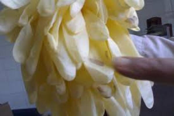 استخراج 16 قفازا من معدة مريض بالسعودية