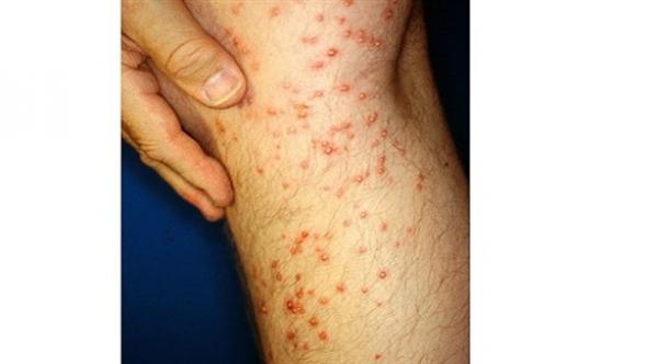 نملة النار الإستوائية "تحرق" إسرائيل