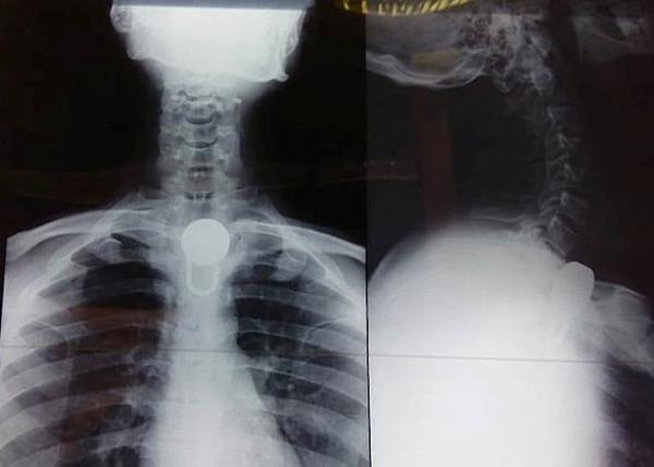 شاب هندي يعاني من مشاكل عقلية يبتلع قفلاً .. فيضطر لإجراء عملية جراحية